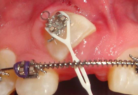 Dentist Elmhurst NY Final Laser Dentistry Result Dentist Elmhurst NY Final Laser Dentistry Result