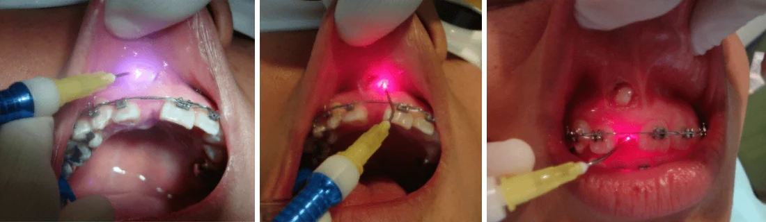 Dentist Elmhurst NY Laser Dentistry Service Dentist Elmhurst NY Laser Dentistry Service